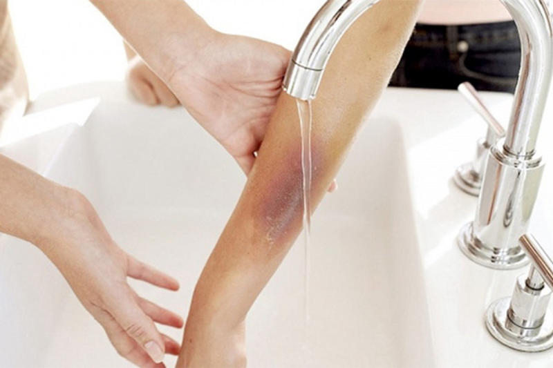 Các bậc phụ huynh cần nắm rõ phương pháp sơ cứu vết bỏng cơ bản Các bậc phụ huynh cần nắm rõ phương pháp sơ cứu vết bỏng cơ bản