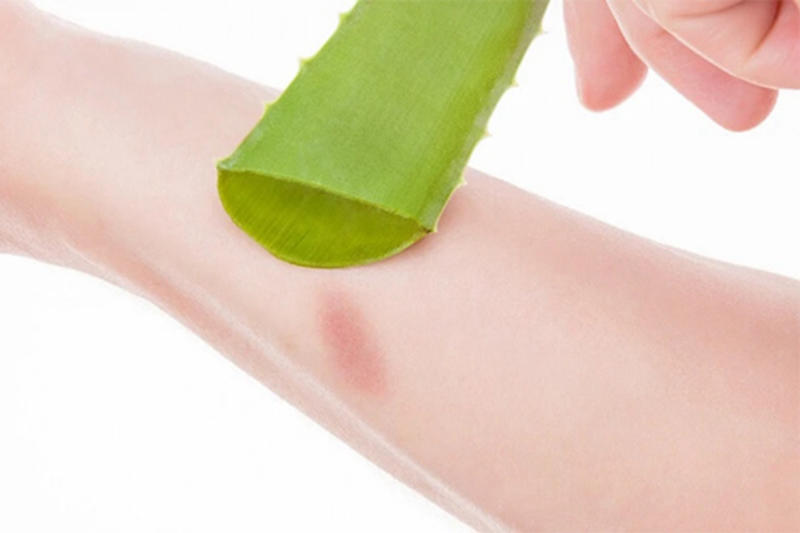 Bố mẹ có thể bôi nha đam lên vết thương bỏng nhẹ của trẻ Bố mẹ có thể bôi nha đam lên vết thương bỏng nhẹ của trẻ